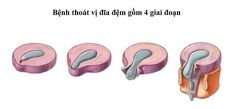 4 GIAI ĐOẠN VÀ BIẾN CHỨNG CỦA THOÁT VỊ ĐĨA ĐỆM. GIẢI PHÁP ĐIỀU TRỊ TỪ THƯƠNG NAM VỚI MÁY KÉO GIẢM ÁP